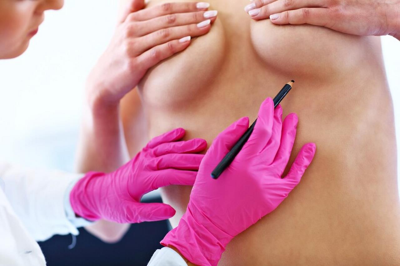 Powiększanie piersi za pomocą implantów – opis zabiegu